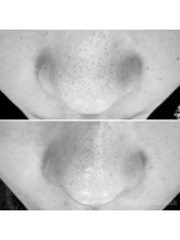 ジュエルオーキッド(Jewel orchids)/ハイドロフェイシャルで毛穴ケア