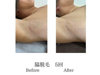 メンズミーシェ(Men's Meshie)/脇脱毛