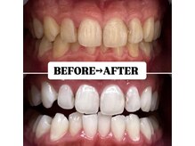 ホワイトニングサロン 豊中/Before&After美白ホワイトニング