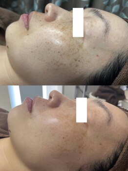 クリスタル(Crystal)/肌に優しい最新最先端のシミケア