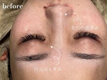 ドクターエイチ 四ツ橋堀江店(Doctor.H)/ハイドロ＋無針水光注入