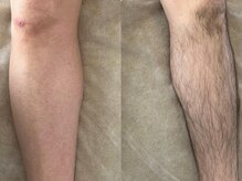 アンベリール(Embellir)/男性★膝下ワックス脱毛