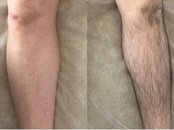 アンベリール(Embellir)/男性★膝下ワックス脱毛