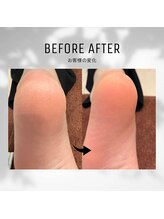 ビューティーサロンレモン(Lemon)/かかとクイックピーリング