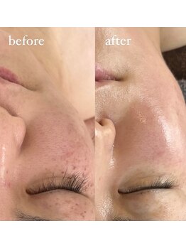 ビタザボナ(Vita the Bona)/幹細胞フェイシャル