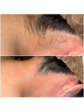 エースタイル(A-style.)/うなじ☆シュガーリング脱毛