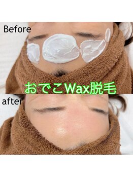 ルミエール(LUMIE’RE)/おでこのフェイシャルWax脱毛