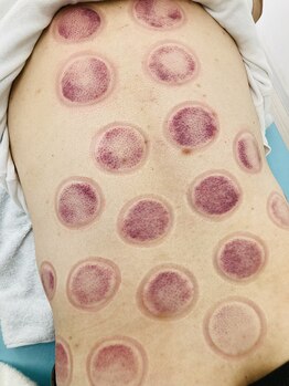 そら鍼灸整骨院/★カッピング★