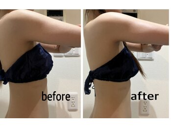 スキニー 六本木店(Skinnie)/ブラックスタンプ6Ｐ二の腕