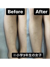 サマラボ 笹塚店(Sama Labo)/キッズ脱毛　子供脱毛