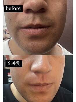 ヴィーナス(Venus)/髭脱毛 6回後