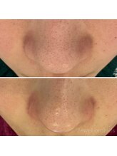 ジュエルオーキッド(Jewel orchids)/ハイドロフェイシャルで毛穴ケア