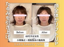 ルルラボ(LuLu beauty labo)/たるみ改善で印象UP！