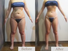 ウエスト・太もも【セルライトケア痩身◎】Before /After