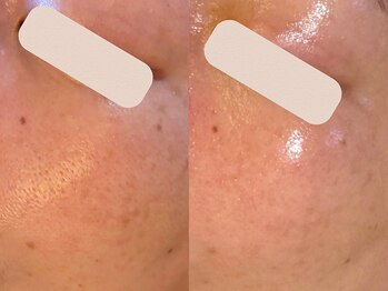 アン(An)/お肌変化