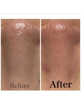 レティティア(Laetitia)/毛穴洗浄＋ハイドロジェリー