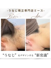 ミース 長野店/うなじ矯正◆ビフォーアフター