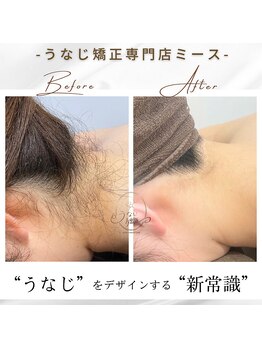 ミース 長野店/うなじ矯正◆ビフォーアフター