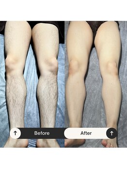 ユーフェム(U-fem)/下半身3回目のお客様