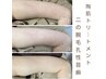 【二の腕のブツブツ！毛孔性苔癬にも◎】剥けない★ハーブピーリング￥5,500