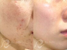 シエルフチュール(CielFutur)/リベルハーブピーリング