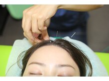 鍼灸治療院 森空堂 本院/頭の鍼は気持ちいい。