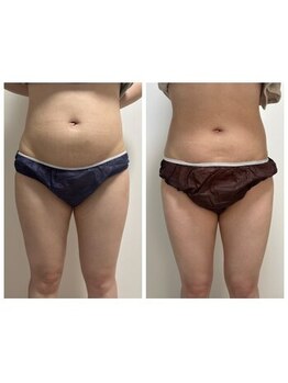 オンケイ(Onkei)/インディバお腹ビフォーアフター