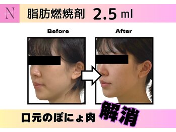 ナチュリ センター南院(NACHUL)/【脂肪燃焼】最新施術で小顔