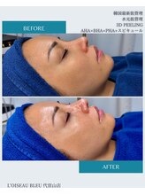 ロワゾーブリュ 代官山店(L'oiseau Bleu)/韓国3D peel