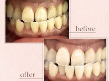 ルアナシンフォニア エクシア 恵比寿店(Luana-Sinfonia)/ホワイトニングビフォーアフター