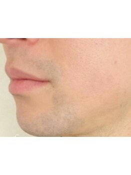 メンズフェイシャル