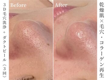 ゼアー(THERE FY.)/乾燥性の毛穴の開きに