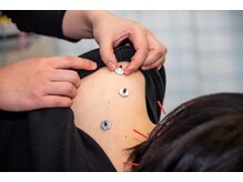 【鍼はハマる人がハマります】首肩コリに、痛みの少ない鍼ケア