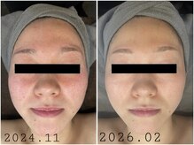 レイズ(RAISE)/当店人気No.1 水光ピーリング