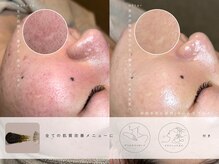 ルーツリー(Rootree)の雰囲気（肌質改善メニューには、デコルテとヘッドスパ付き。）