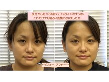 ビューティーパンク 黒田鍼治療院(Beauty Punc)/来院70分後は