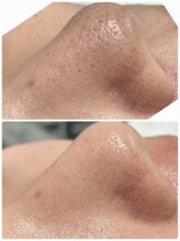 ルアナ(Luana)/【韓国式3D毛穴洗浄】