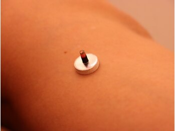 鍼灸整体ととのう 別府本院/お灸(せんねん灸の奇跡使用)