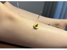 円山よもぎ鍼灸整骨院/鍼灸【むくみ＊冷え＊】