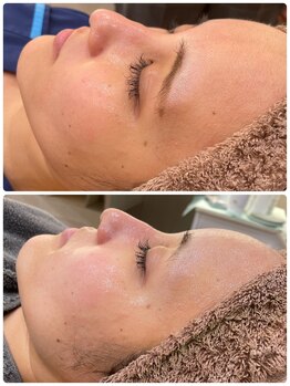 スペチアーレ 夙川/REVIのハーブピーリングで陶器肌