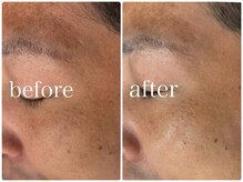 クラスペディア 嘉島店/ララピール＆バイオゲルマスク