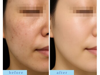 アフロディーテ(APHRODITE)/ビフォーアフター