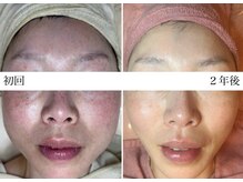 ディンプル(Dimple)/糸リフト＆ハーブピーリング