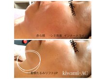 あらゆるお悩みにを解決★最先端kiwami導入サロン【鳴海/豊明】