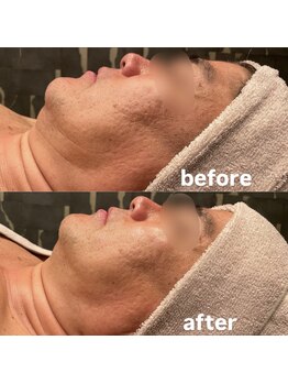 ビュウナ 銀座(BEAUNA)/カルテットモード全顔