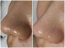 サラグランデ(Sara Grande)の雰囲気（大人気☆毛穴エクストラクション　男性OK【@SARAGRANDE_SALON】）