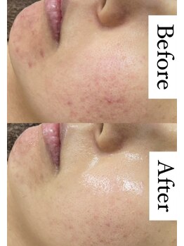 カルディエ(Cardie)/肌質改善　ビフォーアフター