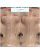 クレア(Clair)/アンストレス症例