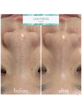 クレア(Clair)/アンストレス症例