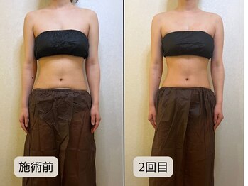 優子さんの美容矯正サロン/ブライダル痩身2回目の変化